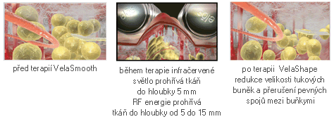 Syneron-velashape-princip