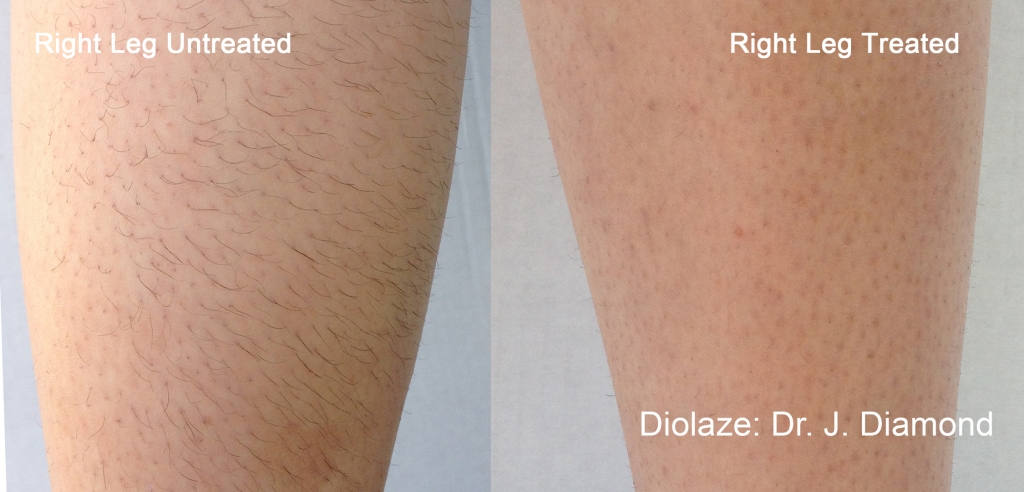 inmide-diolaze-nohy