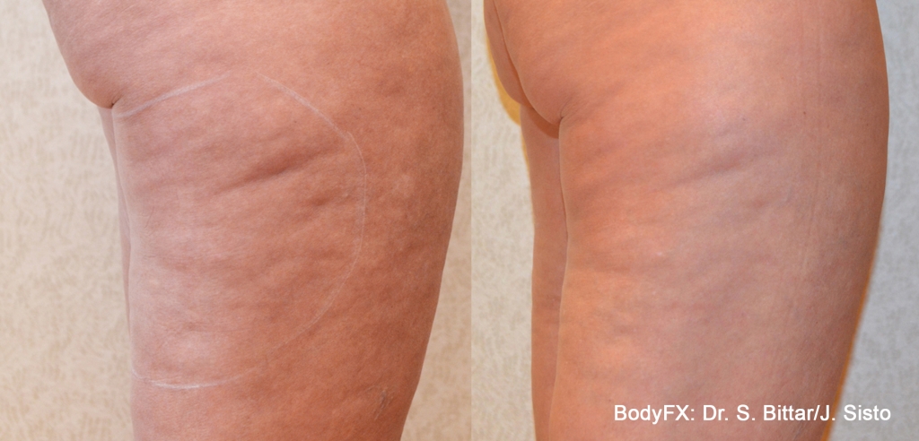 inmode-body-fx-stehna