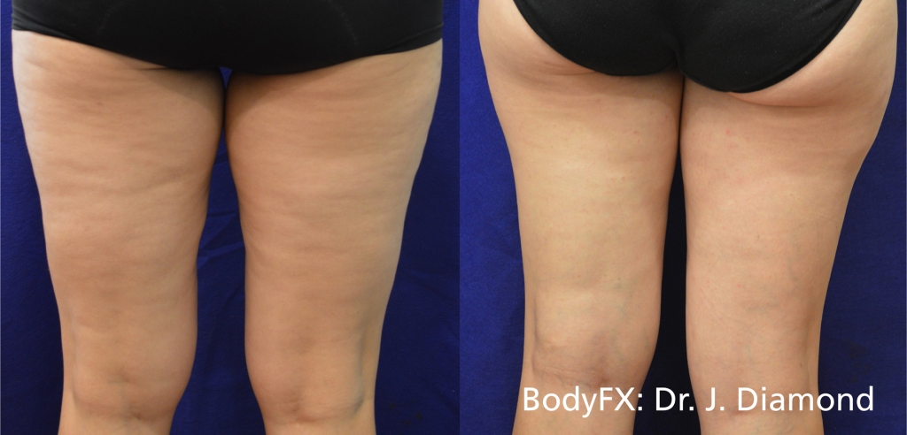 inmode-body-fx-stehna-zadni_